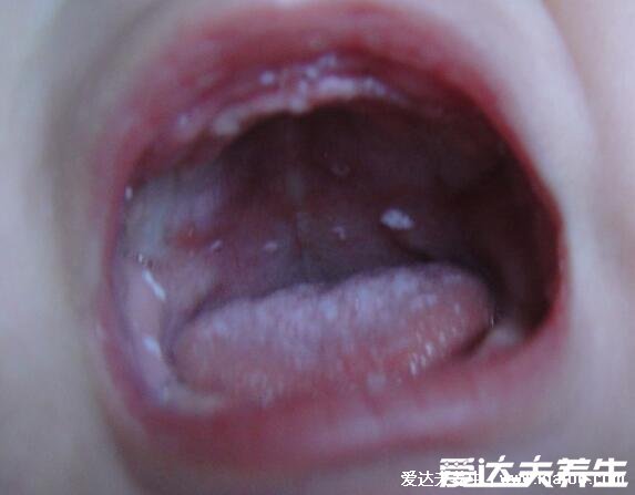 初早期婴儿鹅口疮图片及症状图，感染轻微不疼但可进食痛苦(类似奶快)