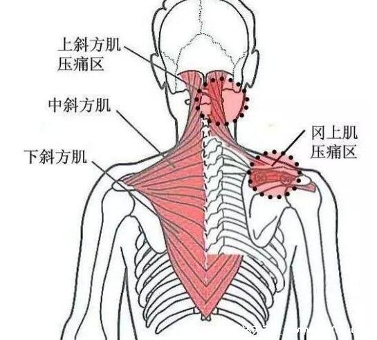 背部筋膜炎疼痛位置图，身体背部各部位疼痛对比图