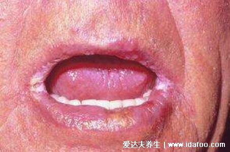 初期口角炎图片及症状，嘴角起疱会糜烂结痂(3种类型附医治法)