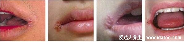 初期口角炎图片及症状，嘴角起疱会糜烂结痂(3种类型附医治法)