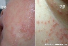 18种常见的痒皮肤病(常见的皮肤病疣)