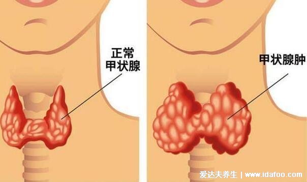 女性甲状腺的前兆图片,甲减会导致容貌异常还影响生育