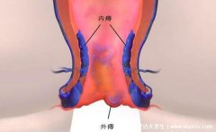 痔疮长什么样的图片，轻微痔疮真实图片全集。