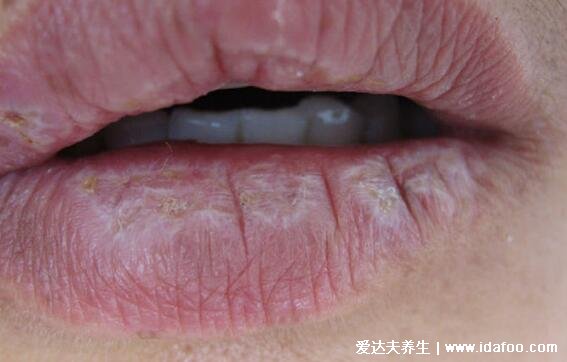 扁平苔藓图片症状,口腔长白斑/皮肤上有紫红色扁平丘疹