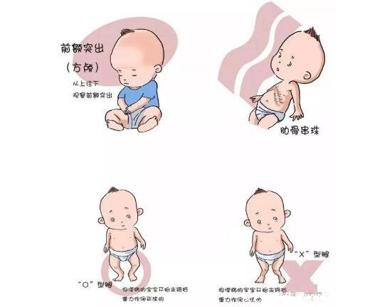 婴儿佝偻病睡姿图片,警惕骨骼发育的4种情况(平躺睡觉)