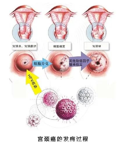 感染HPV病毒 就会恶变成宫颈癌吗？造成宫颈癌的真正真相究竟是什么？