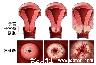 感染HPV病毒 就会恶变成宫颈癌吗？造成宫颈癌的真正真相究竟是什么？