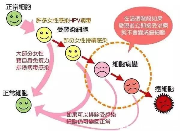 感染HPV病毒 就会恶变成宫颈癌吗？造成宫颈癌的真正真相究竟是什么？